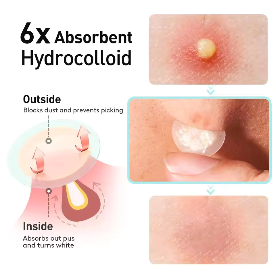 360개/박스 여드름 패치 - 무알콜, 여드름 분비물을 - Face Oil 리뷰 및 가격